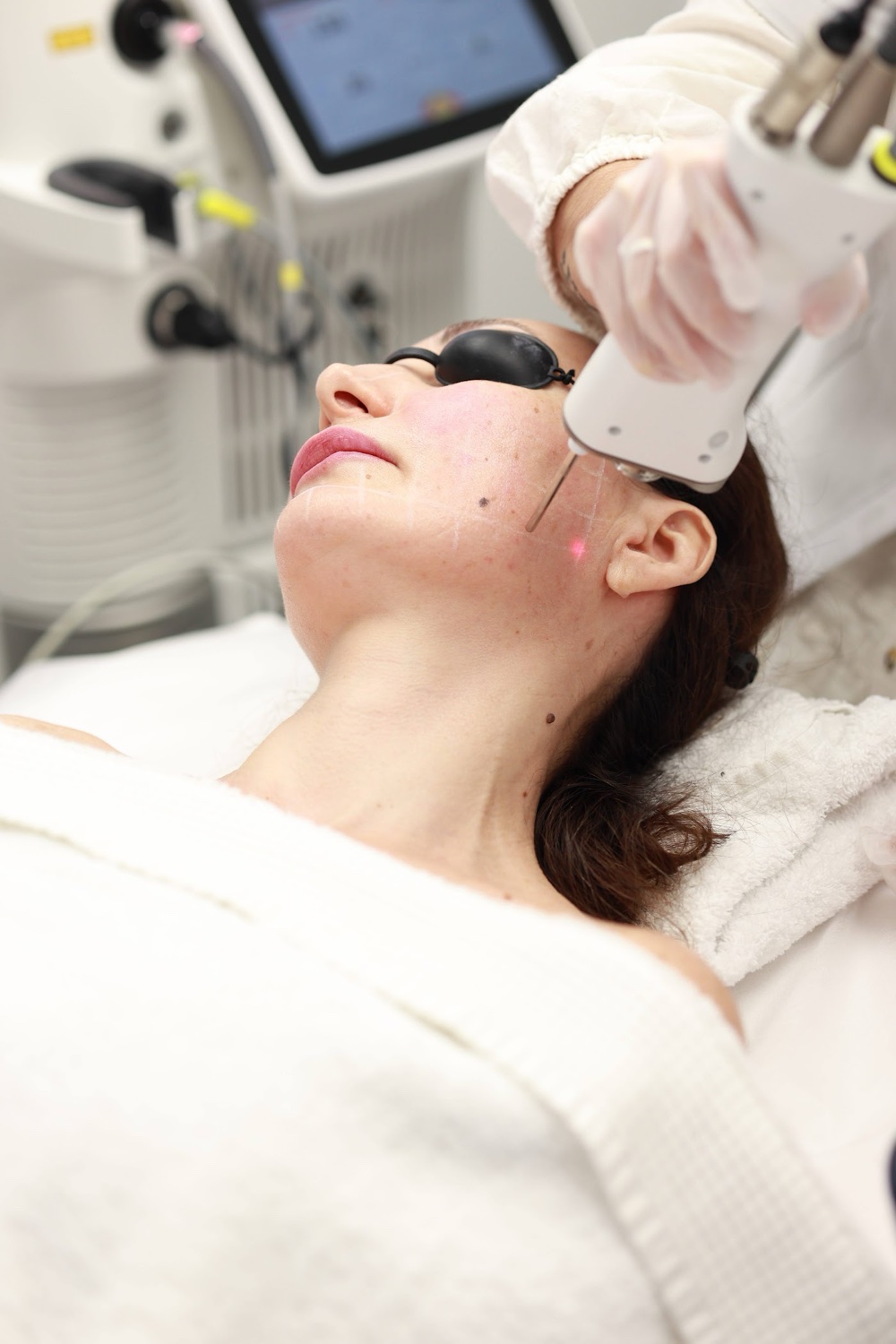 Tratamiento láser facial en Impuls Longevity Barcelona